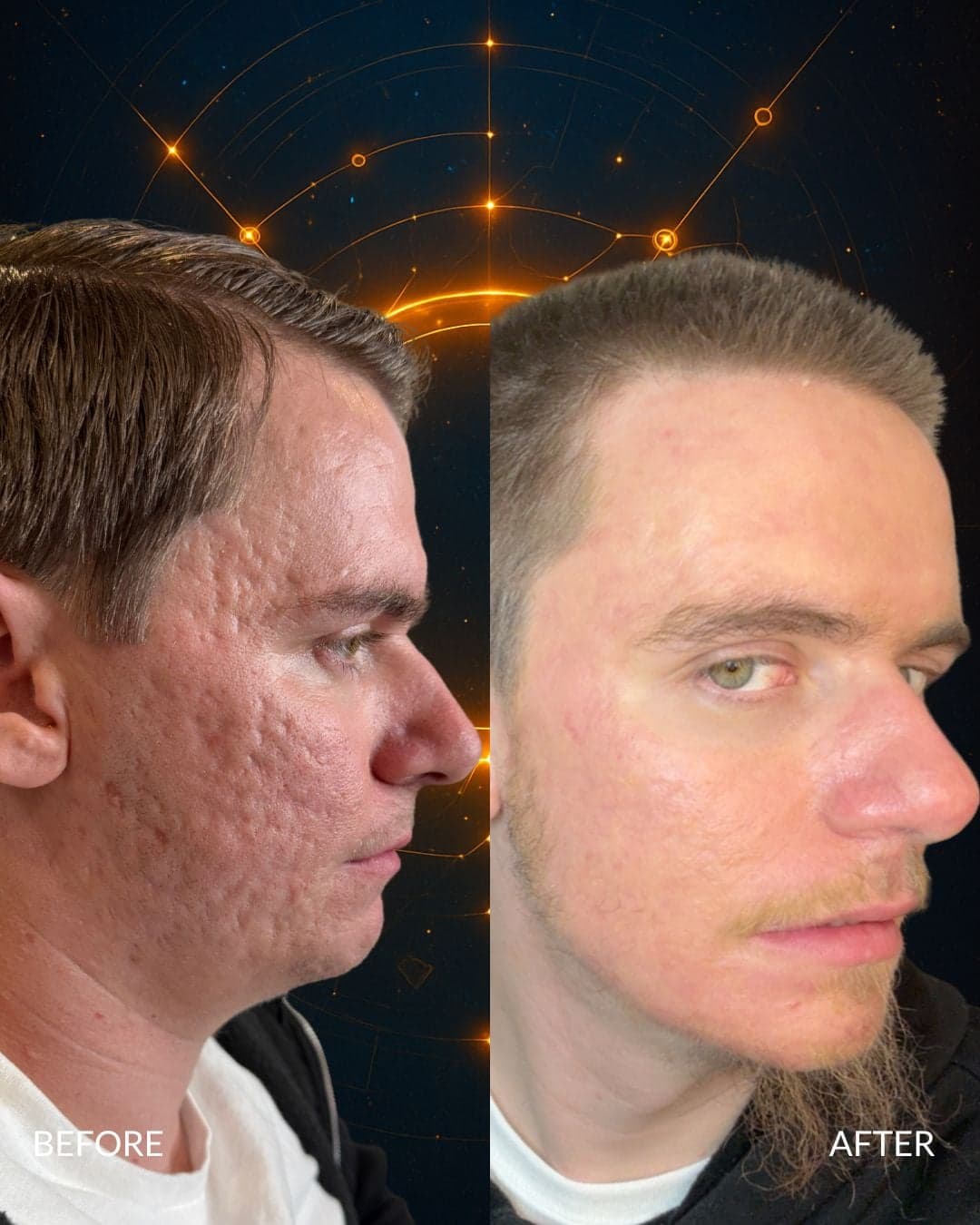 Acne Scar Treatment — before and after