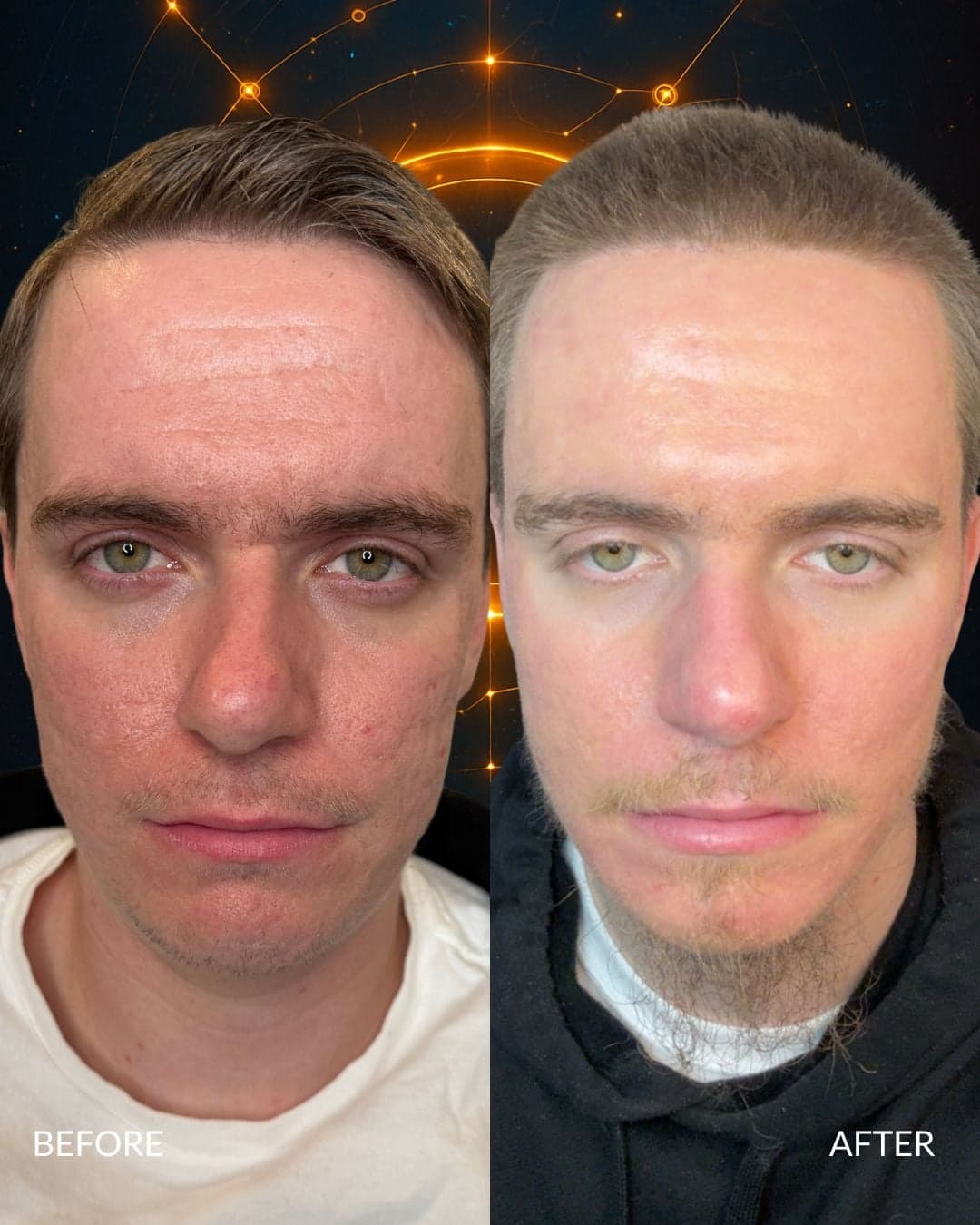 Acne Scar Treatment — before and after