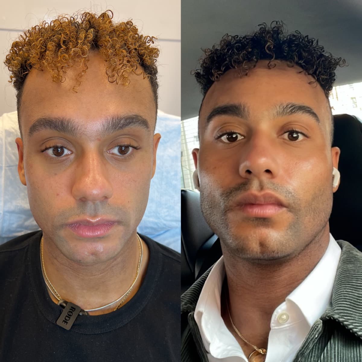 J.A. before