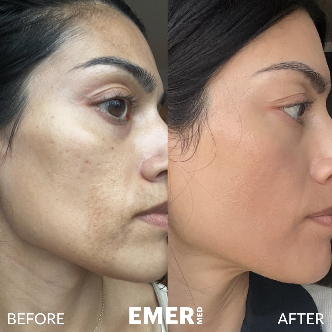 Acne Scar Treatment — before and after