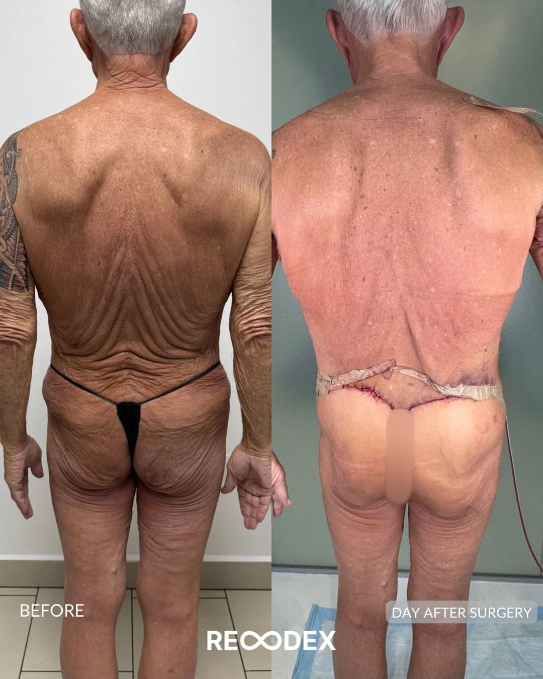 MAXORIS Body Sculpting Before and After
